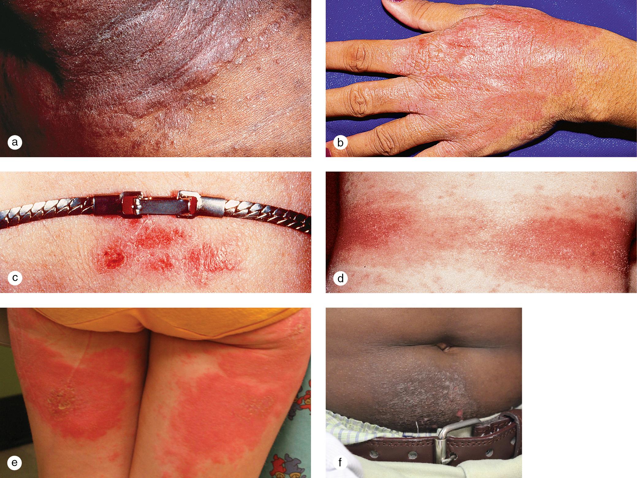 Fig. 3.14, Allergic contact dermatitis. Allergic contact dermatitis as a result of the application of benzocaine demonstrates sharply demarcated, hyperpigmented, lichenified patches on (a) the neck and (b) the top of the hands. (c) The location of the rash helps determine the cause of a contact dermatitis, such as in this girl with a nickel allergy. (d) This child became sensitized to the elastic waistbands of his underwear. (e) An 11-year-old girl had a persistent itchy dermatitis for 6 months, which resolved after she started using a paper toilet seat cover at school. (f) This 9-year-old boy with a history of atopic dermatitis developed a chronic nickel contact dermatitis, which cleared when his parents switched him to a metal buckle-free belt.