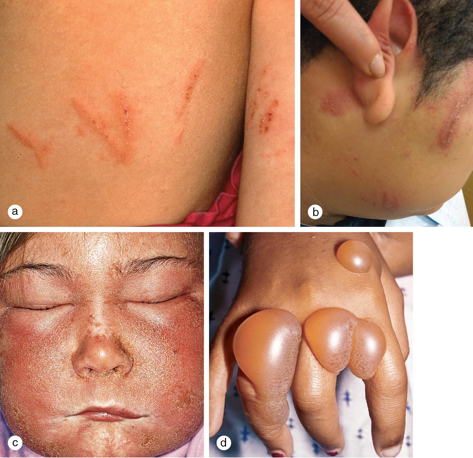 Fig. 3.15, Poison ivy or rhus dermatitis. (a) Crusted papules forming linear plaques were noted on the left side of the abdomen and left arm of this 11-year-old boy several days after a hike in the woods. (b) Similar lesions appeared on the face of this 7-year-old boy. (c) A 10-year-old girl developed intense facial edema after brushing against poison ivy. (d) In highly sensitized children, large blisters can develop. This child was swinging from vines in the woods.