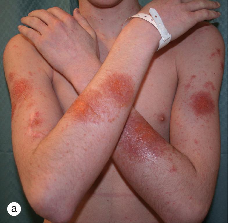 Fig. 3.17, (a) An adolescent boy developed severe poison ivy contact dermatitis on his arms the day after a hike in the woods. (b) The next day a widespread, itchy eczematous papular eruption appeared on his trunk and extremities.