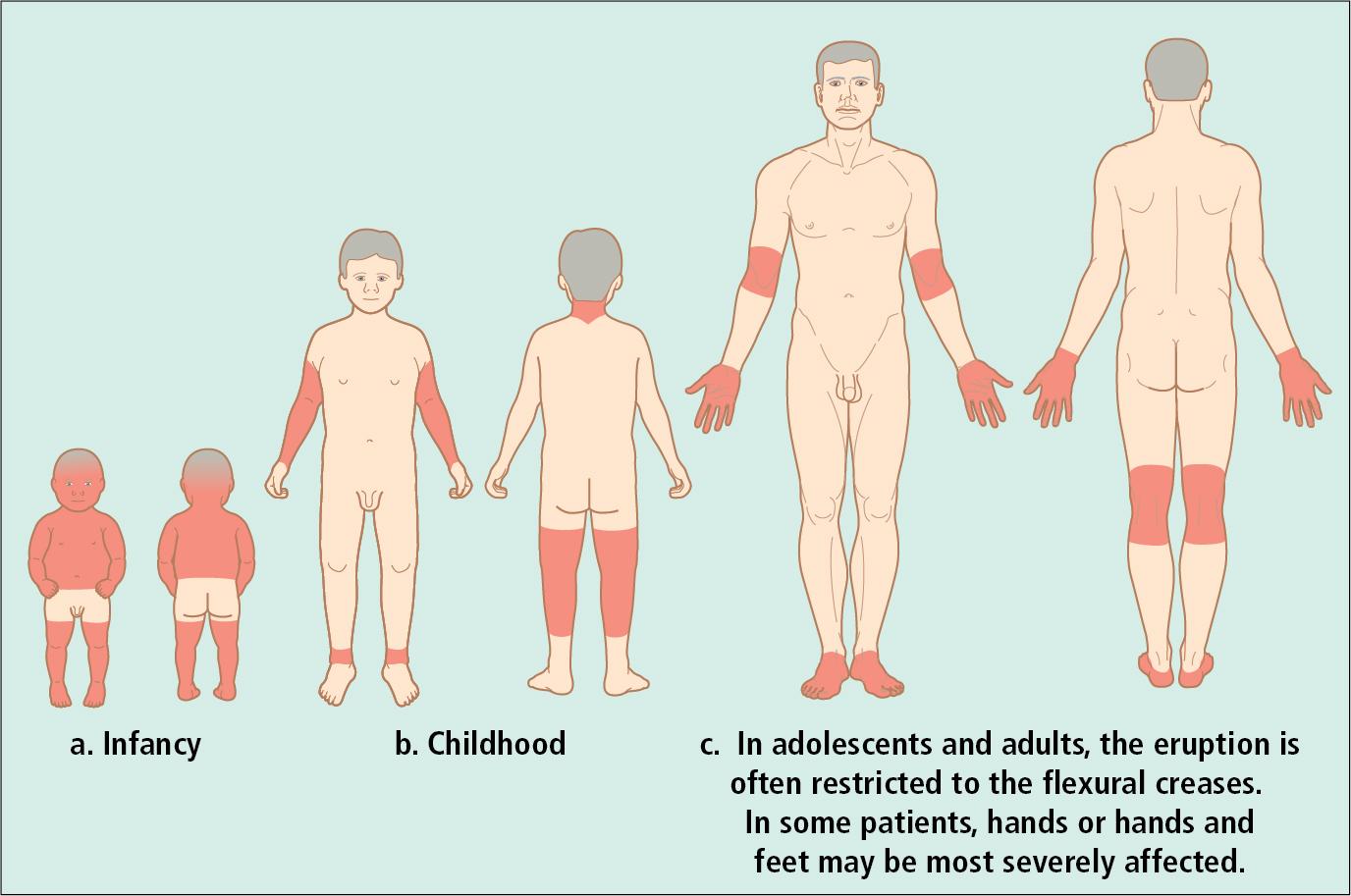 Fig. 3.19, Characteristic distribution of lesions of atopic dermatitis in infancy, childhood, and adulthood. (a) In infancy, widespread lesions may be generalized, sparing only the diaper area. The head and neck, as well as the flexural and extensor surfaces of the distal extremities, are often severely involved. (b) In older childhood, lesions tend to involve the flexural surfaces of the upper and lower extremities, as well as the neck. With severe flares of disease activity, the rash may become more generalized. (c) In adolescents and adults, the eruption is often restricted to the flexural creases. In some patients, hands or hands and feet, may be most severely affected.