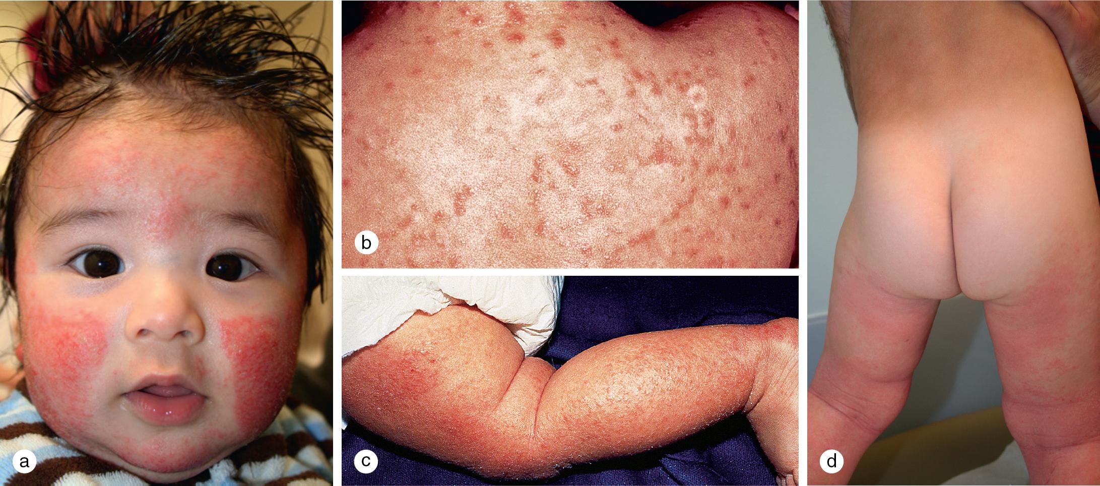 Fig. 3.20, Infantile eczema. (a) This infant has an acute, weeping dermatitis on the cheeks and forehead. Involvement of (b) the trunk and (c) the extremities with erythema, scaling, and crusting is evident. Note the severe involvement of the extensor surfaces of the leg and sparing of the leg crease. (d) Usually the diaper area is the only portion of the skin surface that is spared.