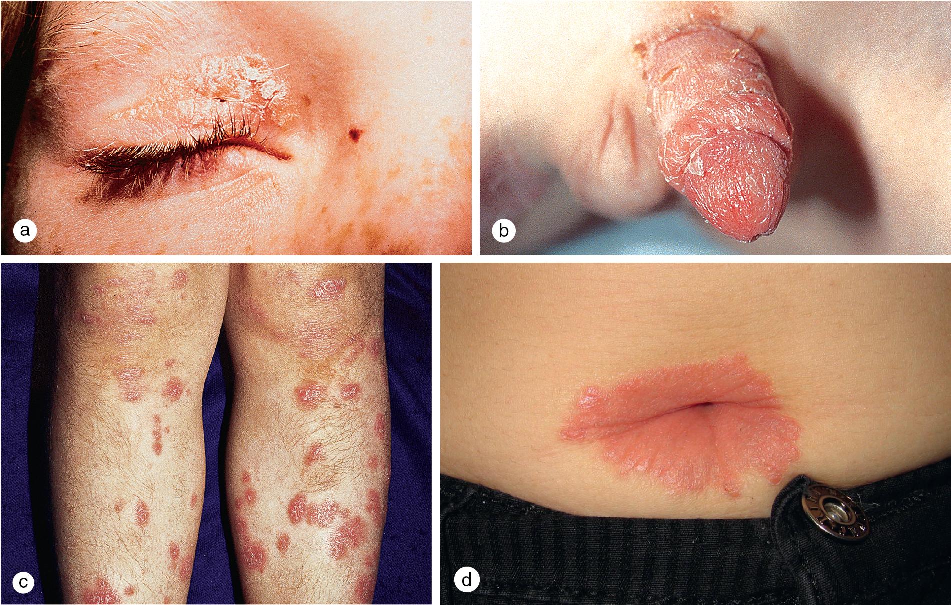 Fig. 3.2, These lesions were present on the (a) eyelids, (b) penis, and navel of this 8-year-old boy for 6 months before (c) he developed widespread papules and plaques on his arms and legs. (d) This 11-year-old girl had a persistent periumbilical plaque for over a year.