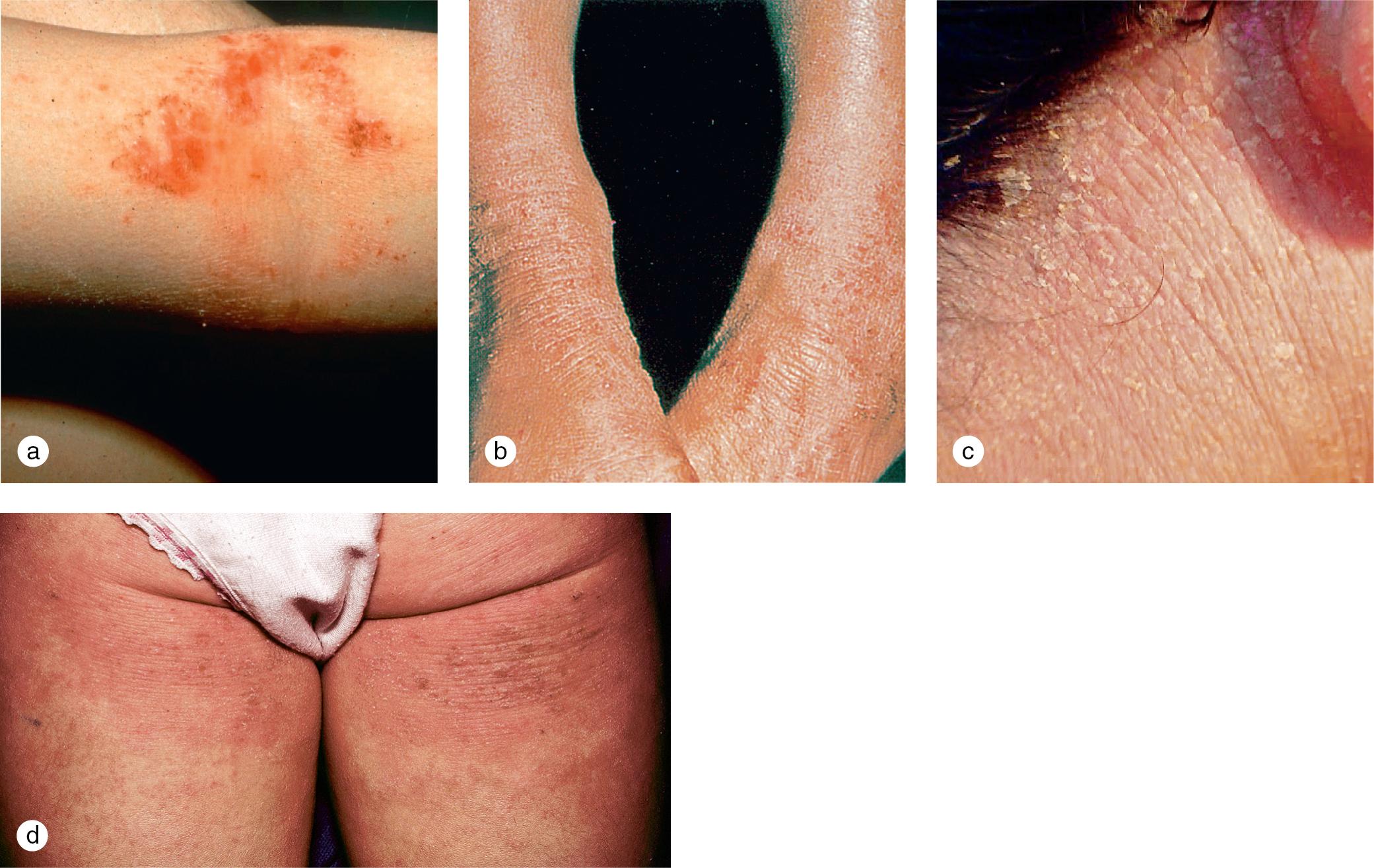 Fig. 3.21, Childhood eczema with lesions on (a) the arm, (b) the ankles, (c) the neck, and (d) the buttock creases.