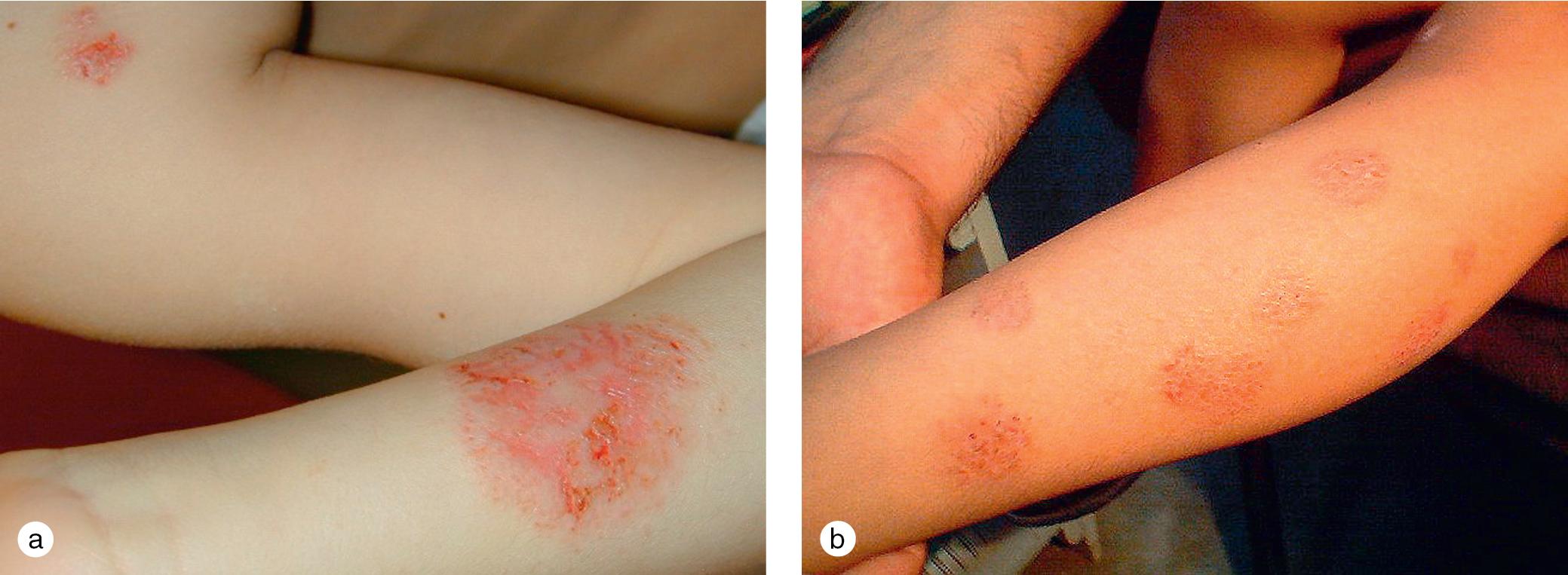 Fig. 3.22, Nummular eczema. (a) An adolescent demonstrated the acute exudative round patches of nummular eczema. (b) The term nummular eczema is also used to describe the chronic circular patches on the extremities and trunks of atopic patients, exemplified by the patches on another adolescent.
