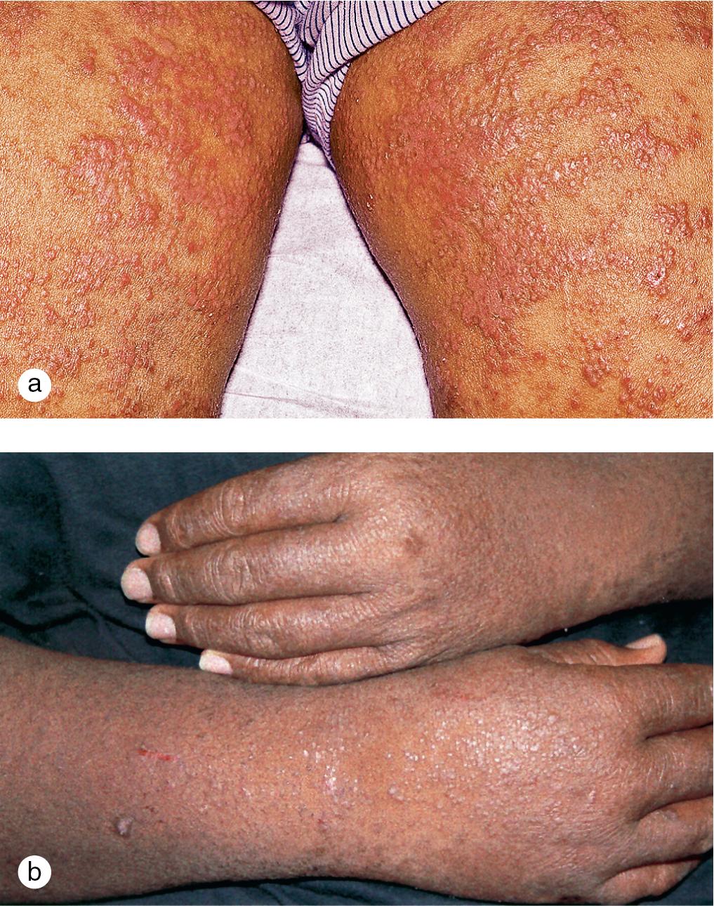 Fig. 3.24, Follicular eczema. In some patients, follicular papules may be the only manifestation of atopic dermatitis. These lesions also occur in many atopic patients during the course of their disease, as in (a) this adolescent with follicular papules on his thighs and legs and (b) a 10-year-old boy with lesions involving his hands and forearms.