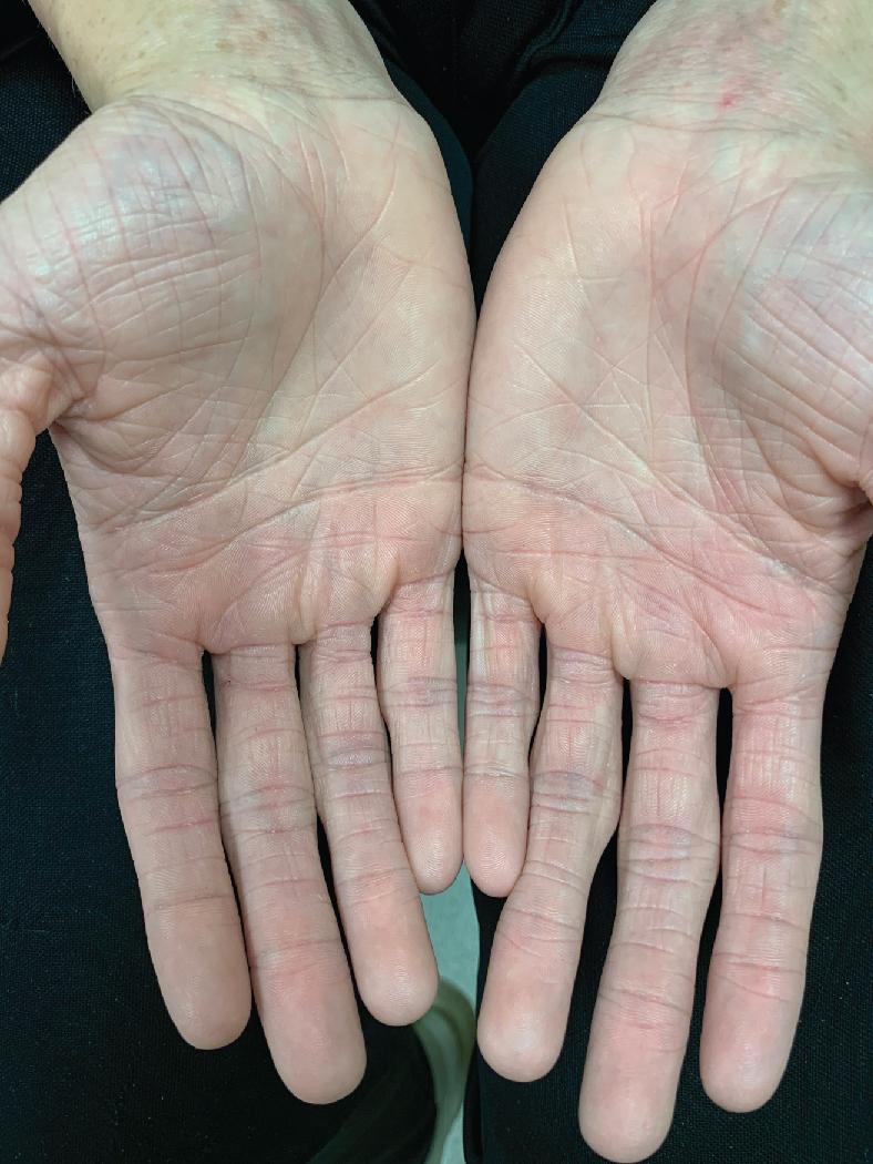 Fig. 3.25, This 14-year-old boy had a history of atopic dermatitis and ichthyosis vulgaris associated with hyperlinearity of the palms and soles and coarse non-inflammatory scale on his legs.