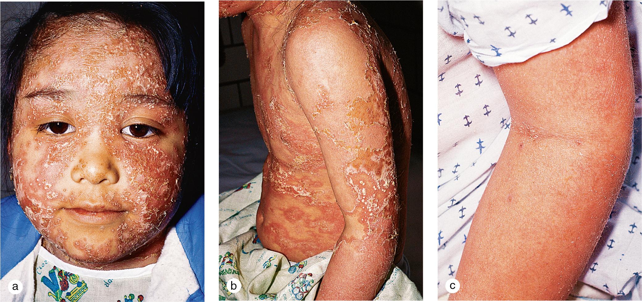 Fig. 3.4, Pustular and erythrodermic psoriasis. (a,b) Generalized pustulation developed suddenly within psoriatic plaques on this 8-year-old child. Skin lesions were associated with fever, chills, and arthralgias. (c) Erythroderma appeared in another 8-year-old girl with psoriasis. She also complained of chills, pruritus, and fatigue.