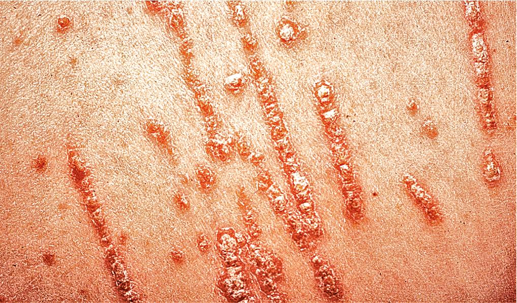 Fig. 3.5, Koebner phenomenon in psoriasis. Pruritus was severe in this child who developed linear plaques in excoriations.