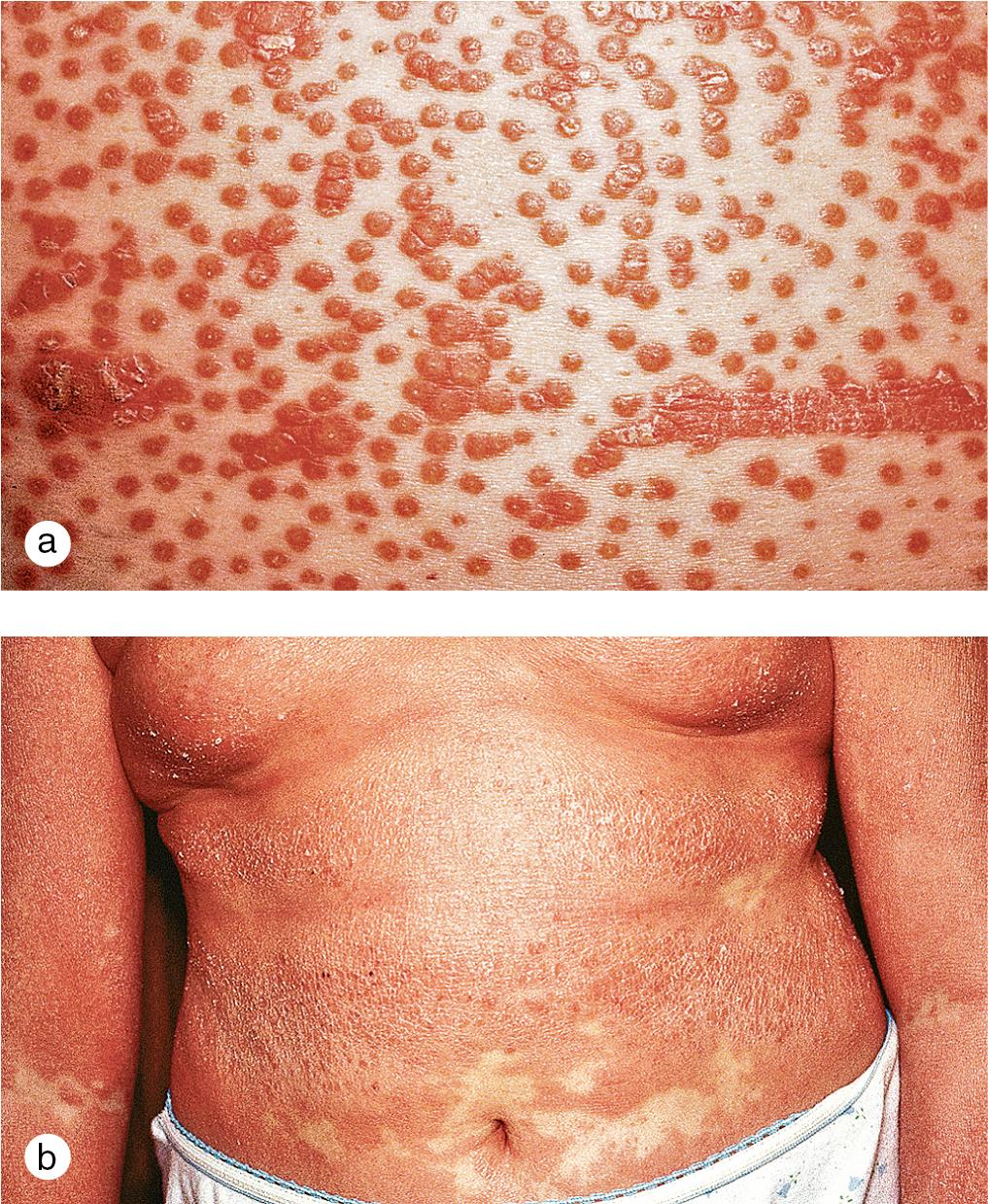 Fig. 3.7, Pityriasis rubra pilaris. (a) Discrete hyperkeratotic follicular papules on the trunk and extremities of this 10-year-old girl progressed over several weeks to give confluent plaques. (b) Note several discrete areas of sparing on the abdomen and arm flexures.