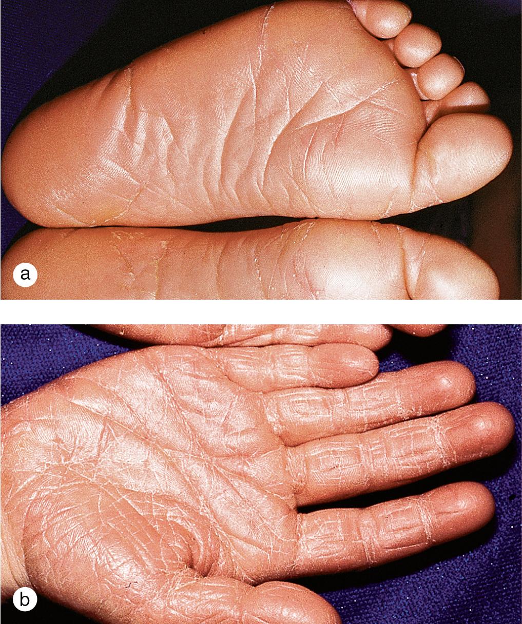 Fig. 3.8, Pityriasis rubra pilaris. This child developed a salmon-colored keratoderma of the (a) soles and (b) palms.