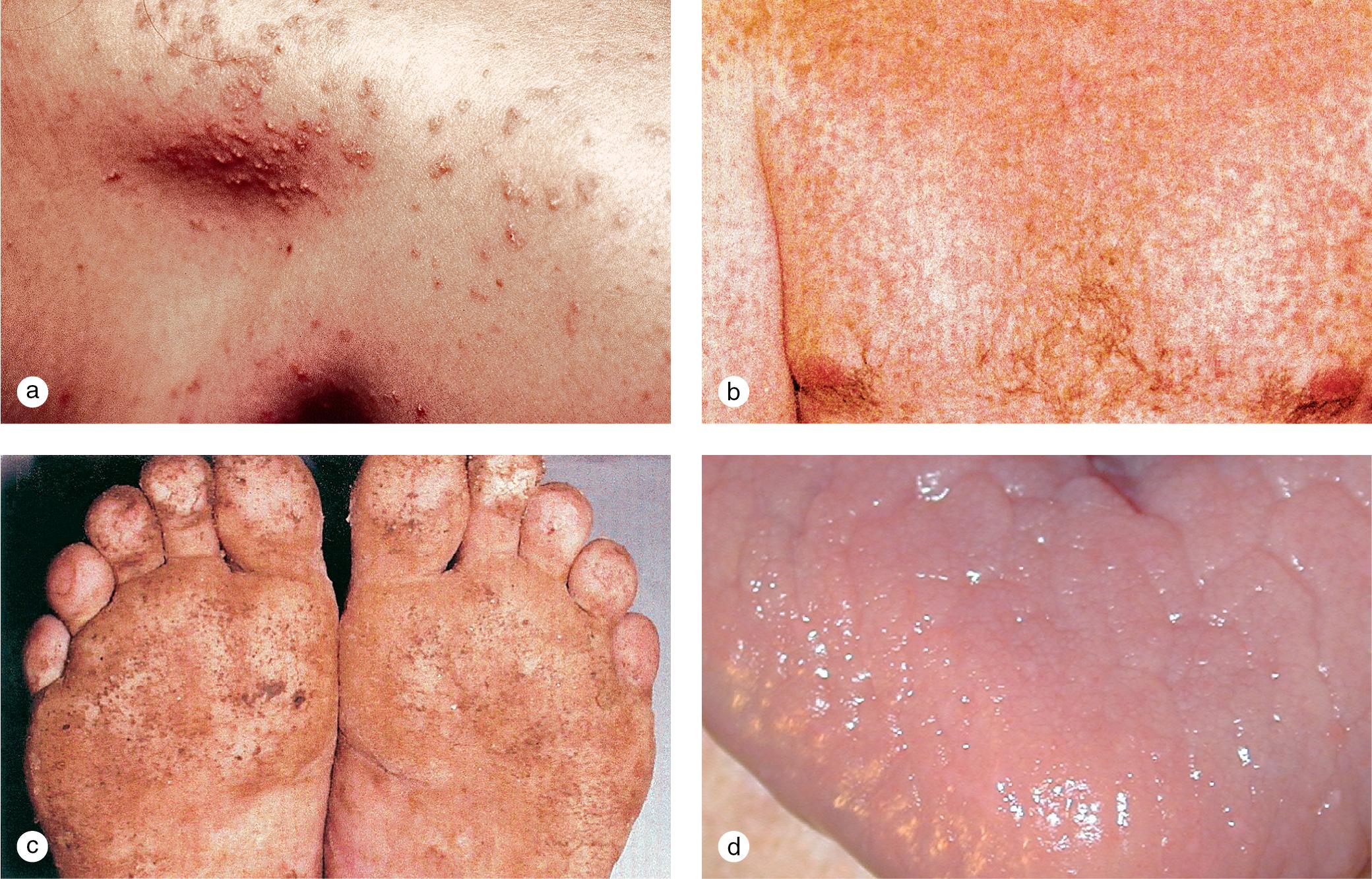 Fig. 3.9, Keratosis follicularis. Hyperkeratotic follicular papules erupted progressively on the trunk and face of this 9-year-old girl. (a) Some of the most prominent lesions are demonstrated on her shoulder. An adolescent demonstrates almost confluent papules on the (b) chest and an associated keratoderma on his (c) feet. (d) Asymptomatic confluent pebbly papules on the tongue of this 20-year-old man were noted with magnification.