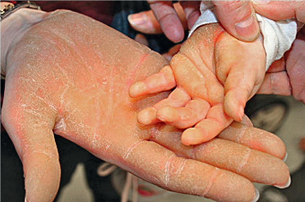 Fig. 3.10, Progressive hyperkeratosis began on the palms and soles of this father and toddler son by 3 months of age.