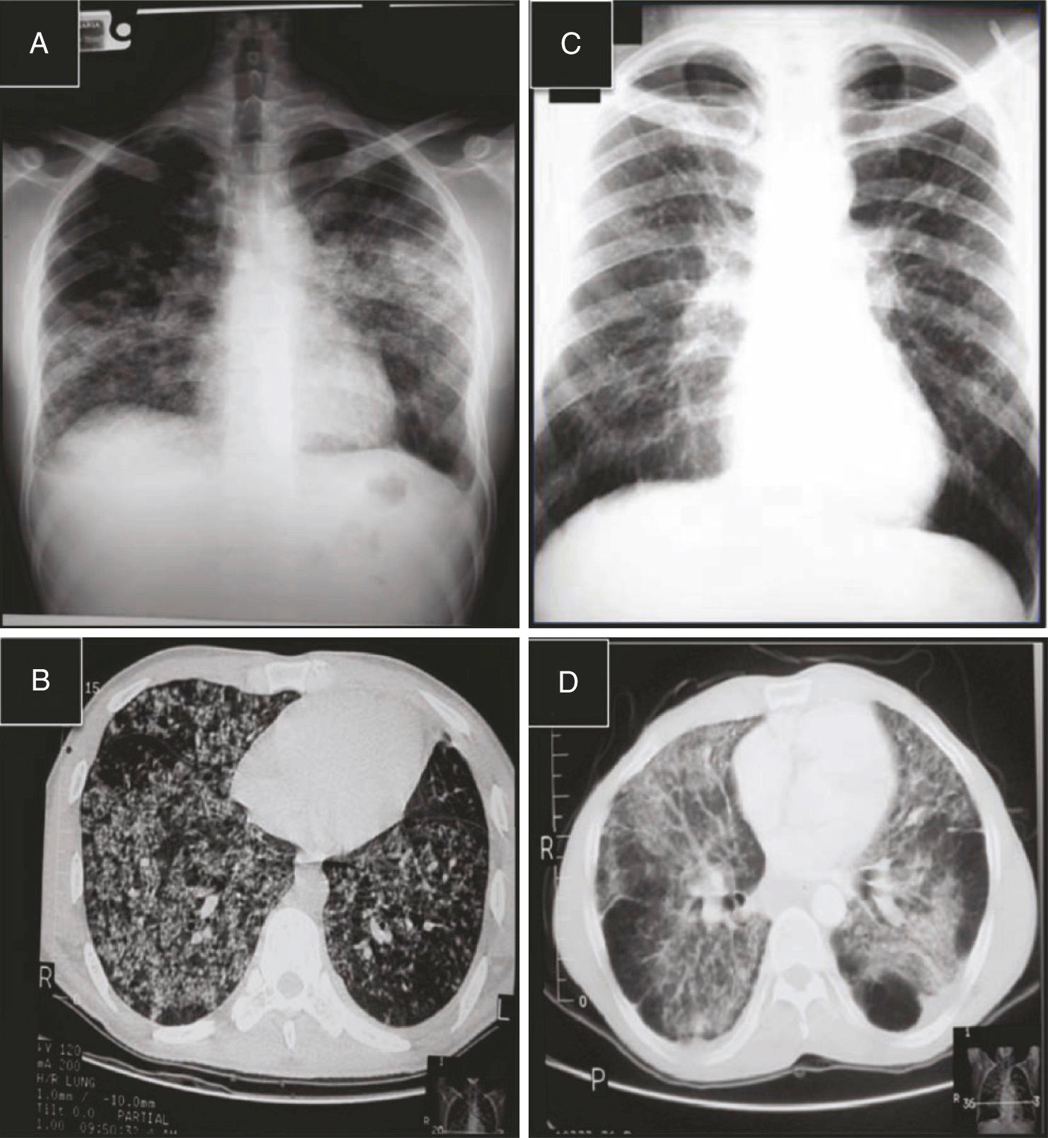 FIG. 267.3, Chest radiograph and chest high-resolution computed tomography (CT) scan in paracoccidioidomycosis patients before treatment.