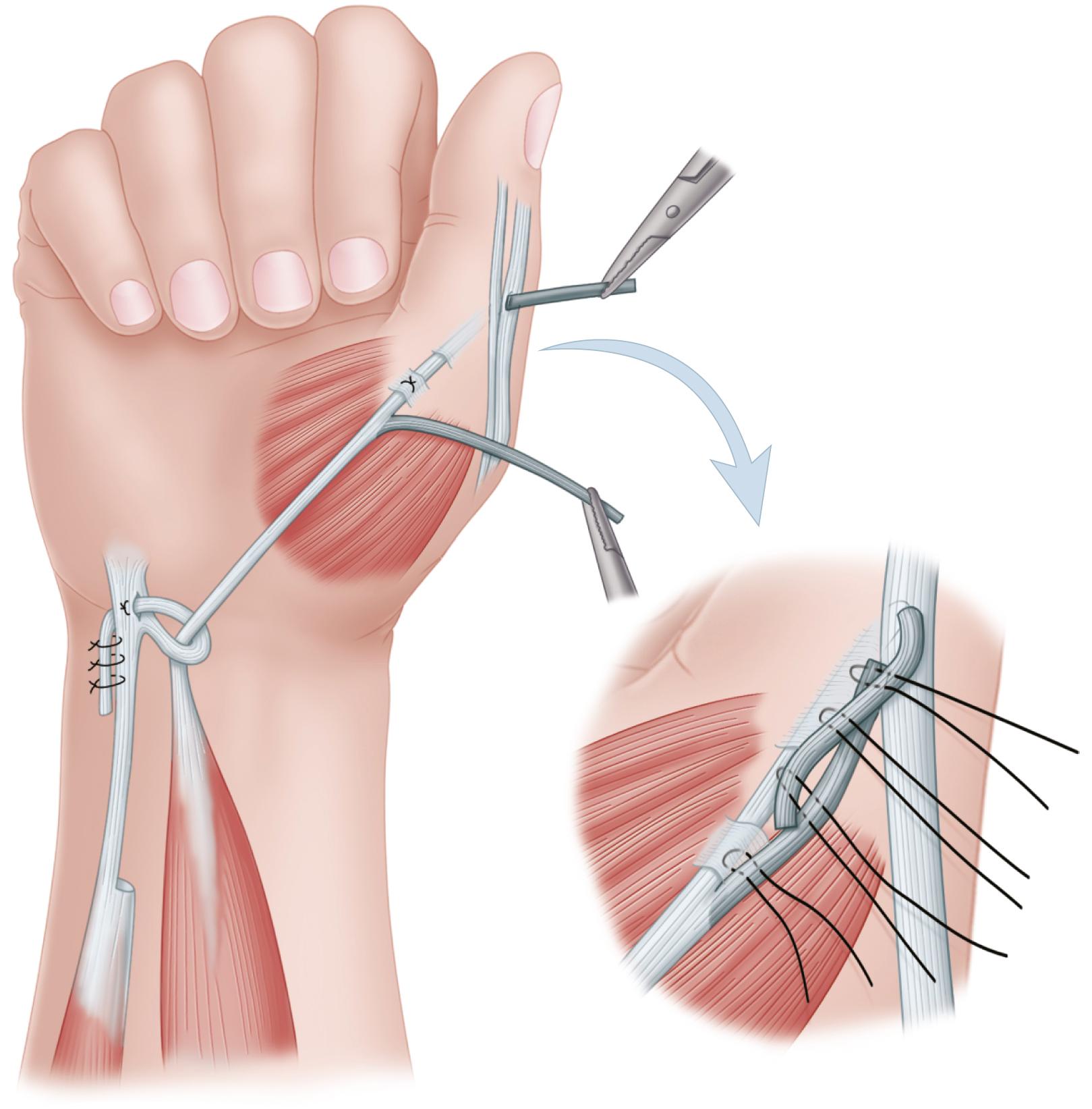 FIGURE 71.4, Riordan transfer to restore opposition (see text). SEE TECHNIQUE 71.1