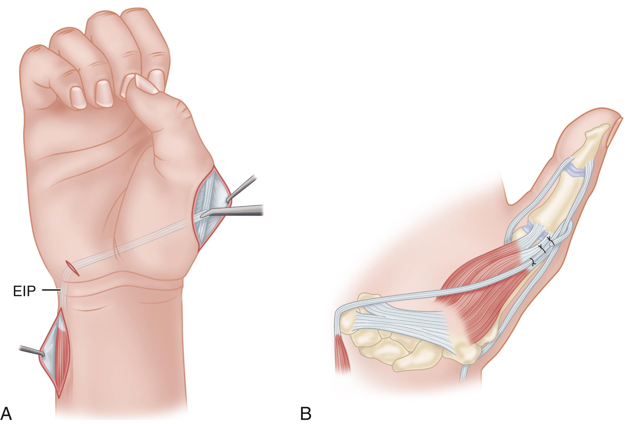 FIGURE 71.7, A, Tendon of extensor indicis proprius (EIP) is brought out in area of pisiform and passed again subcutaneously across palm to thumb. B, Method of attachment to thumb using abductor pollicis brevis tendon, metacarpophalangeal joint capsule, and extensor pollicis longus tendon over proximal phalanx.
