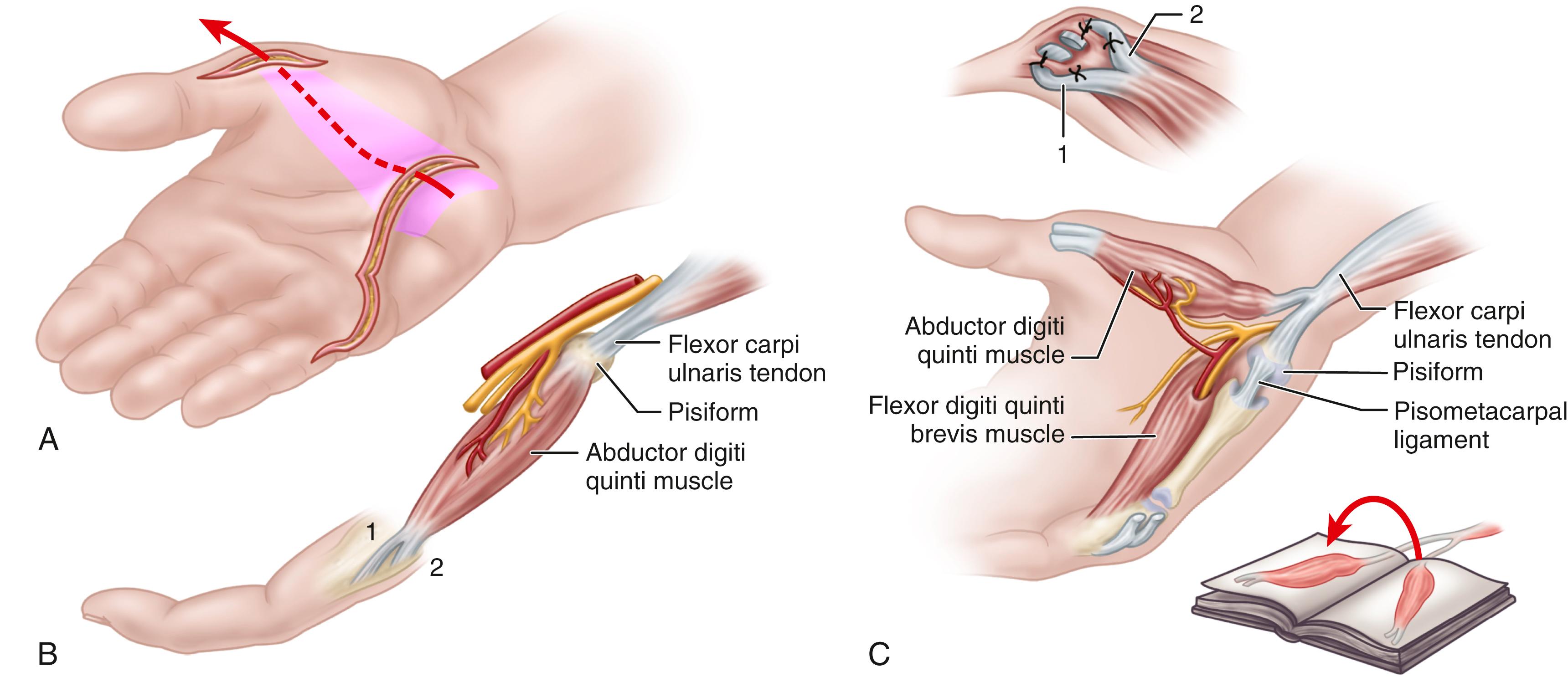 FIGURE 71.9, Littler transfer of abductor digiti quinti to restore opposition. A, Two skin incisions. Intervening skin (shaded area) is undermined, creating pocket to receive transfer. B, Anatomy of abductor digiti quinti. Neurovascular bundle is located proximally on deep surface of muscle. Muscle inserts on proximal phalanx (1) and extensor tendon (2) of little finger. C, Origin of muscle is freed from pisiform but not from flexor carpi ulnaris tendon. Muscle is folded over about 170 degrees and is passed subcutaneously to thenar area, and its two tendons of insertion (1 and 2) are sutured to abductor pollicis brevis tendon.