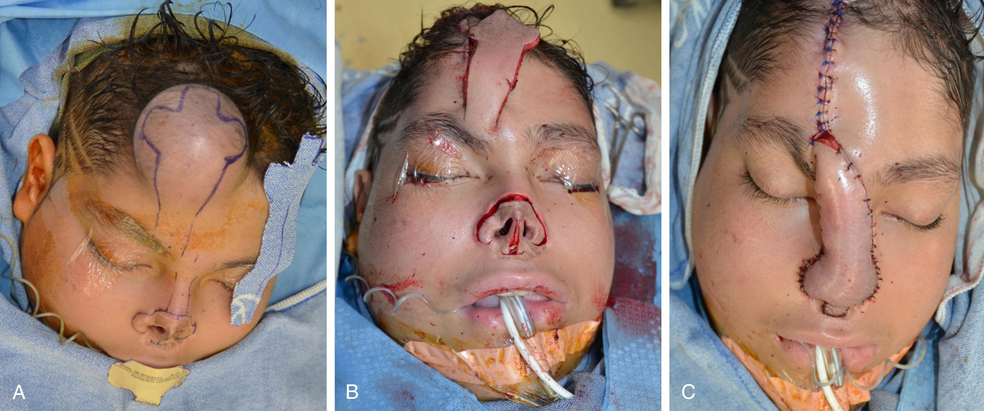 Fig. 165.2, Nasal tip, alae, and columella reconstruction with an expanded forehead flap.