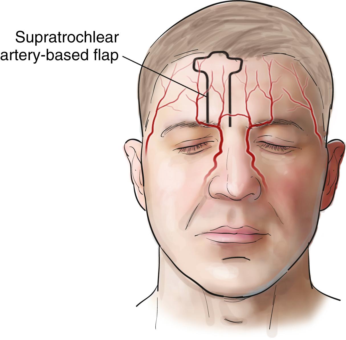 Fig. 165.1, Paramedian forehead flap based on right supratrochlear artery.