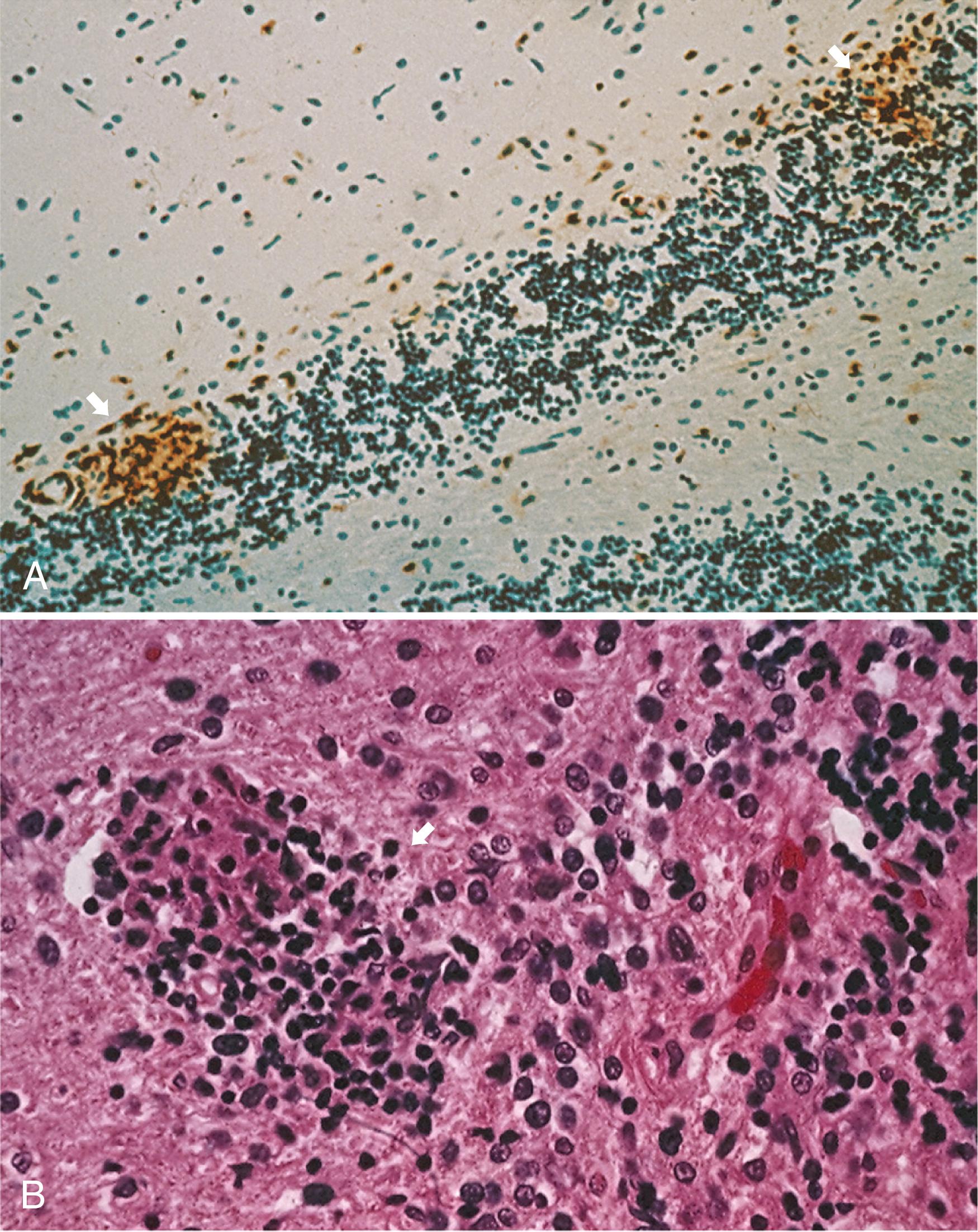 Fig. 81.1, A, Extensive loss of Purkinje cells in a patient with a subacute cerebellar syndrome in the context of encephalomyelitis and anti-Hu antibodies. The arrows showing clusters of CD3 T cells in Purkinje cell layer. B, A higher magnification of the Purkinje cell layer shows a neuronophagic nodule of T lymphocytes that are probably destroying a Purkinje cell. A: (A, ×100, immunostained for CD3 and counterstained with haematoxylin B: × 400 haematoxylin-eosin.