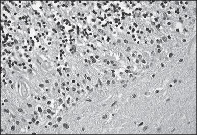 Figure 44.3, Paraneoplastic cerebellar degeneration. A section of cerebellum from a patient with adenocarcinoma of the ovary and paraneoplastic cerebellar degeneration associated with anti-Yo antibodies is shown. Note the Bergmann gliosis and the absence of Purkinje cells, which normally are located between the granular cell layer (top left) and the molecular cell layer (bottom right).