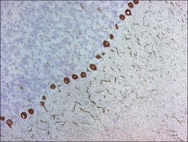 Figure 44.4, Detection of an anti-cerebellar antibody (anti-Tr) in the serum of a patient with paraneoplastic cerebellar degeneration. A frozen section of rat cerebellum incubated with the serum of the patient shows a characteristic dotlike reactivity with the cytoplasm of Purkinje cells and the molecular layer of the cerebellum. This antibody, known as anti-Tr, is a specific marker of paraneoplastic cerebellar degeneration associated with Hodgkin lymphoma.