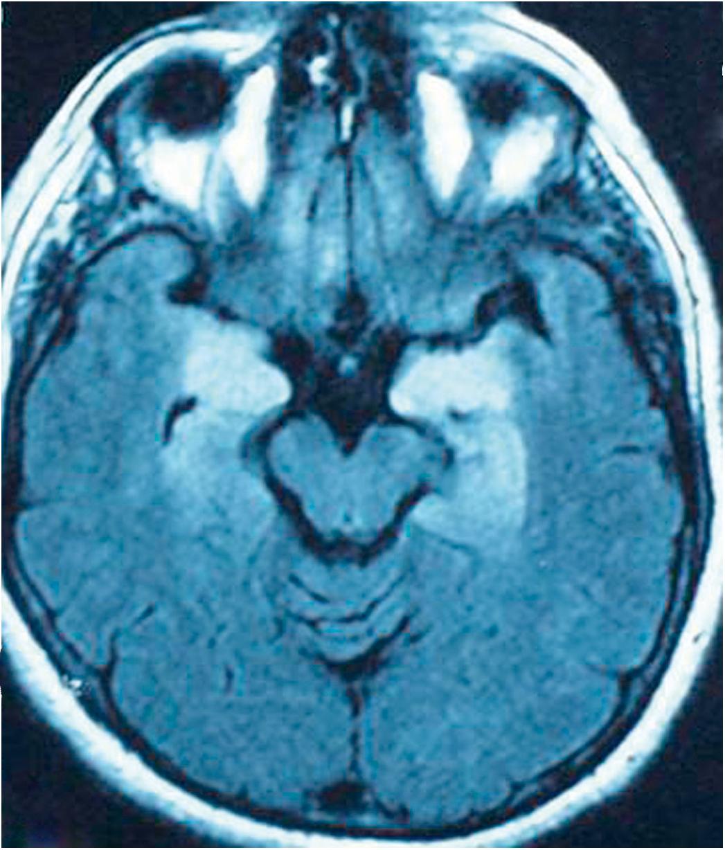 Figure 27-1, Axial fluid-attenuated inversion recovery (FLAIR) magnetic resonance imaging (MRI) of a patient with paraneoplastic limbic encephalopathy. There is marked hyperintensity in the medial temporal lobes bilaterally. In addition, there is slight dilatation of the temporal horns, suggesting atrophy.