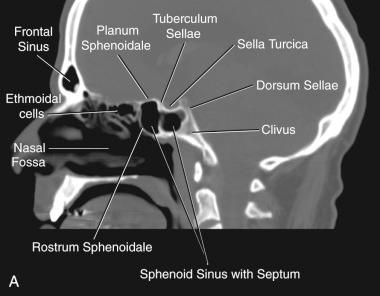 Figure 33.2, Different imaging techniques to understand the parasellar anatomy. (A) Sagittal CT-scan without lesion demonstrating the anatomy of the sella. (B) Sagittal non-contrast T1 MRI without lesion demonstrating the anatomy of the sella. Notice that the anterior and posterior parts of the pituitary gland are distinct on MRI. The anterior part is isointense on T1 while the posterior pituitary (neurohypophysis) has intrinsic high T1 signal. (C) Sagittal contrast-enhanced T1 MRI without lesion. Notice that the pituitary gland and the pituitary stalk are contrast enhancing. This is due to their high vascularity. (D) Coronal contrast-enhanced T1 MRI without lesion. (E) MRA showing the arterial anatomy surrounding the sellar and parasellar regions. ACA, anterior cerebral arery; ICA, internal carotid artery; MCA, middle cerebral artery.