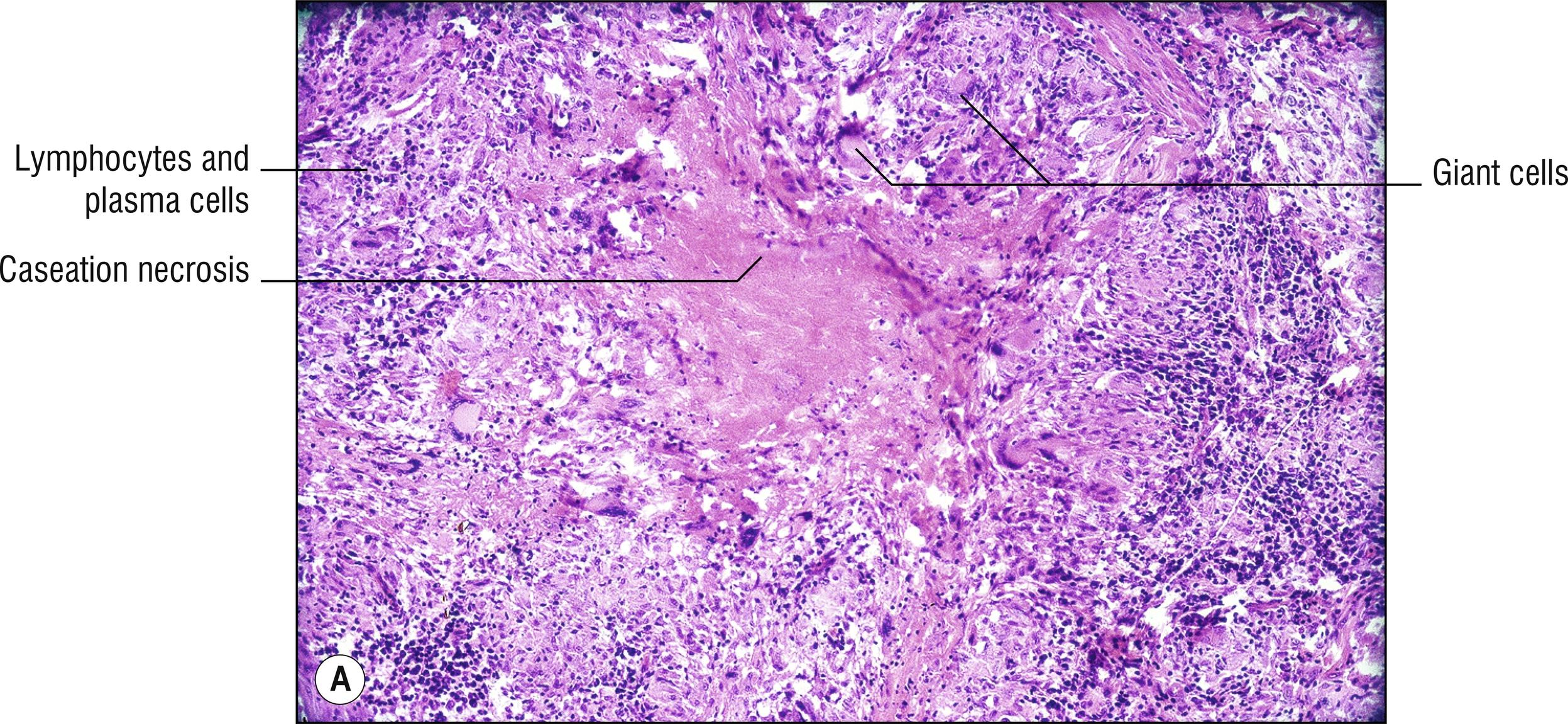 Fig. 15.1, A Leishmaniasis (medium mag.).