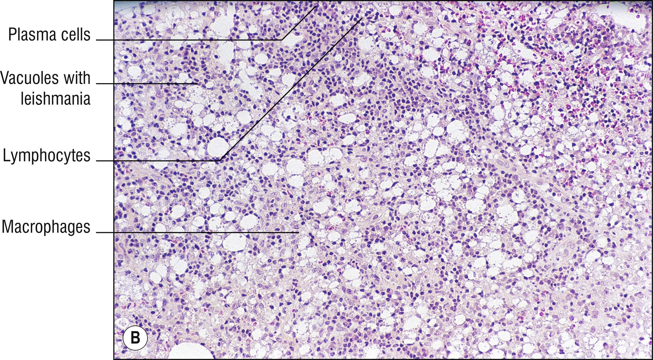 Fig. 15.1, B Leishmaniasis (medium mag.).