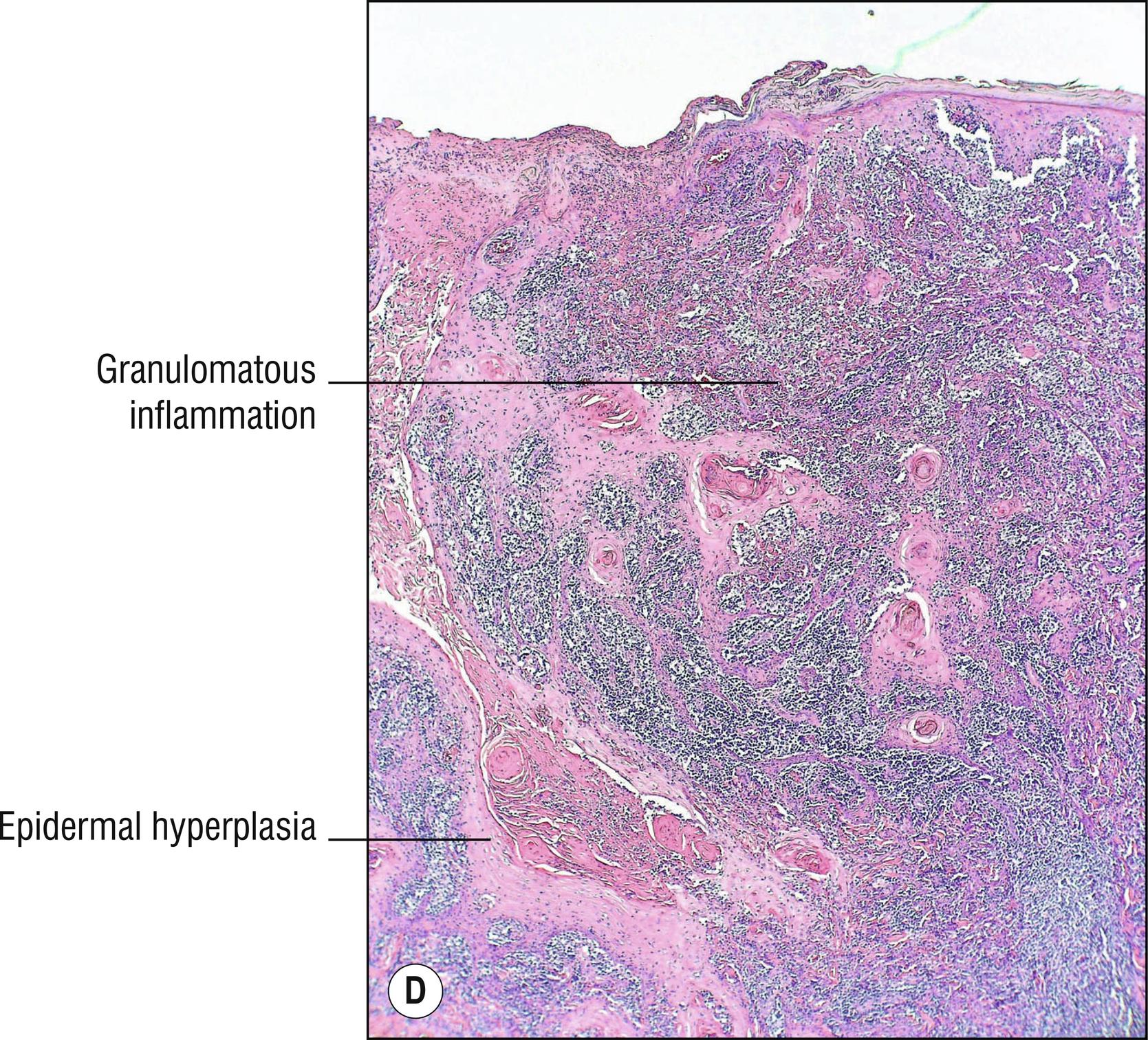 Fig. 15.1, D Pseudocarcinomatous hyperplasia and granulomatous inflammation in leishmaniasis.