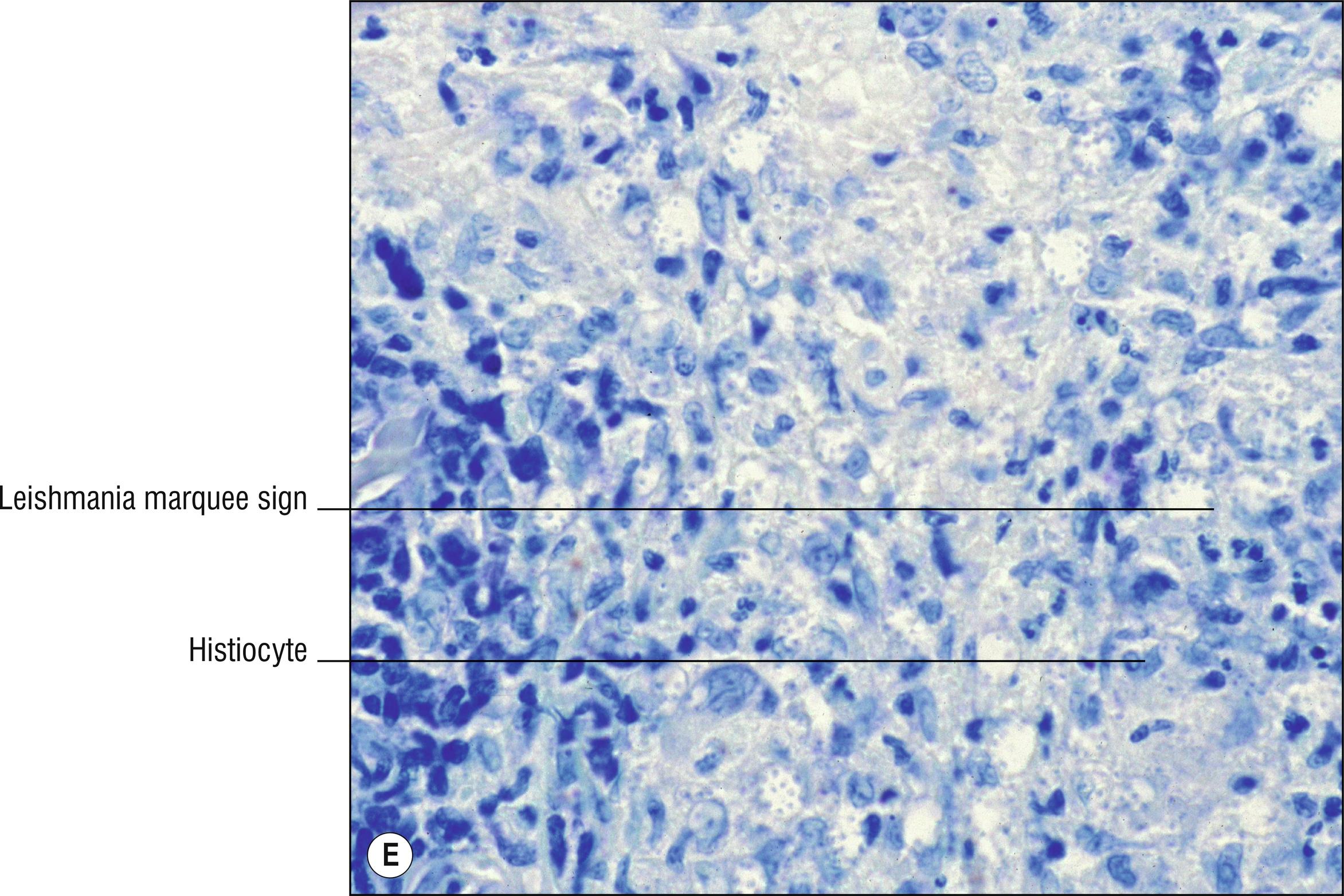 Fig. 15.1, E The organisms of Leishmania may not be more easily seen with this Giemsa stain compared with H&E.