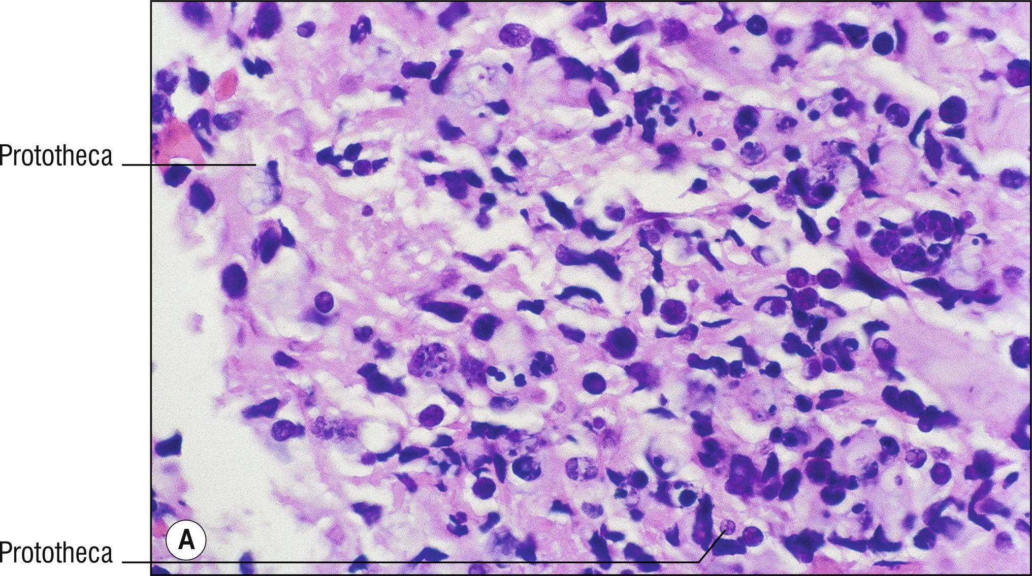 Fig. 15.2, A Protothecosis.