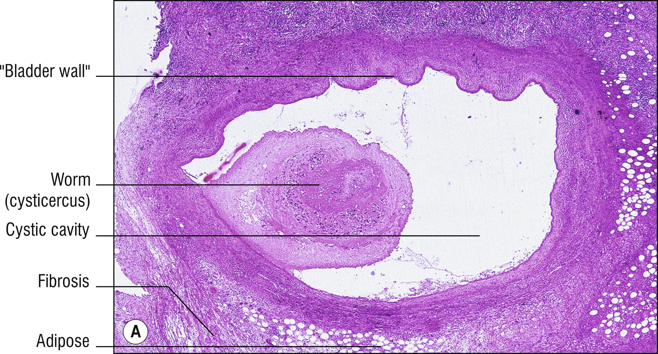 Fig. 15.3, A Cysticercosis.