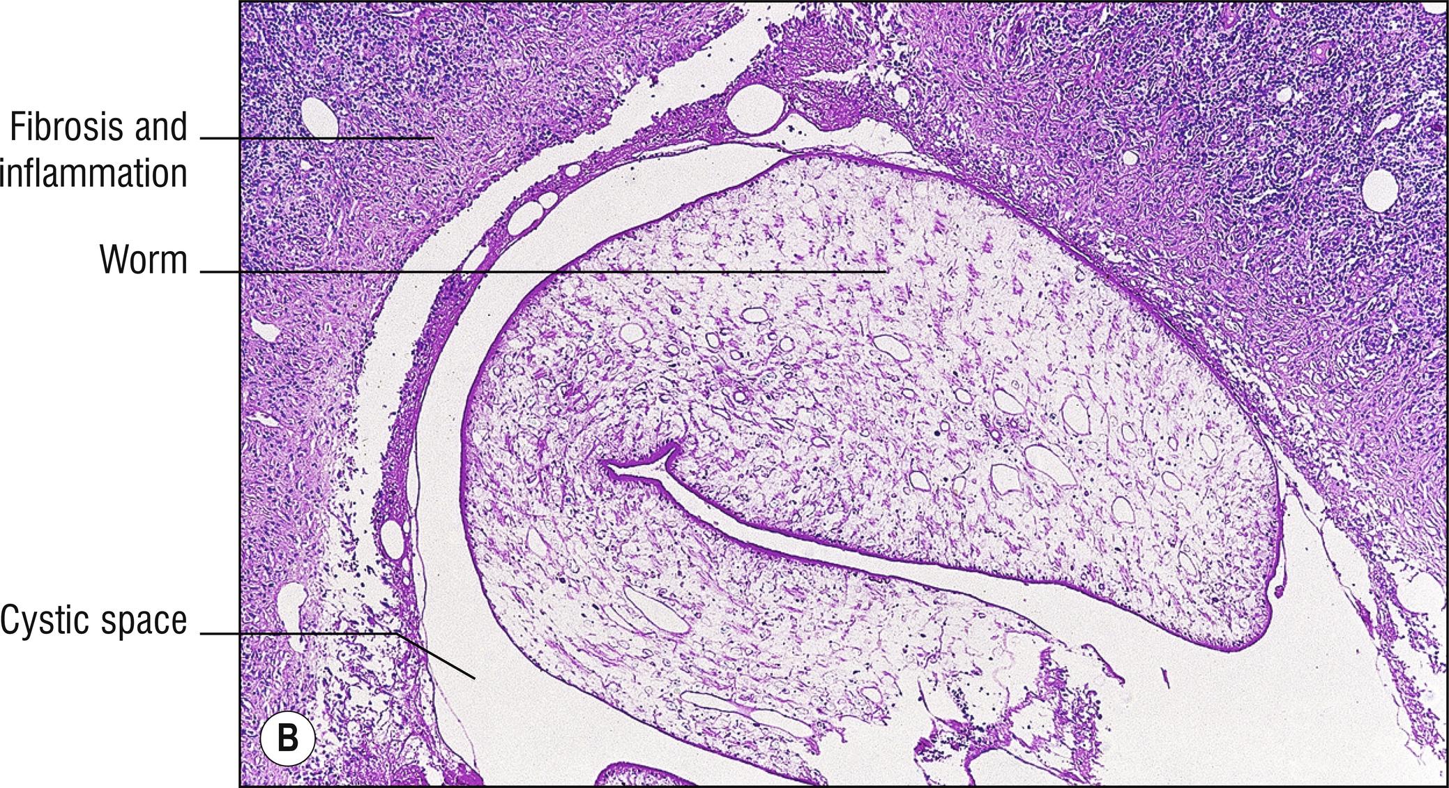 Fig. 15.3, B Sparganosis.