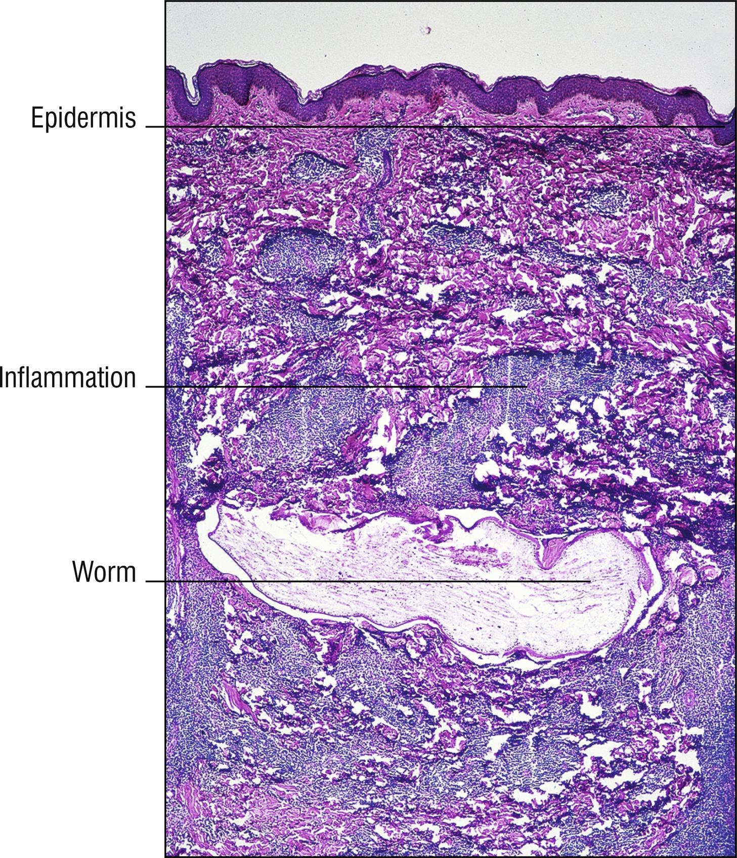 Fig. 15.4, Dirofilariasis.