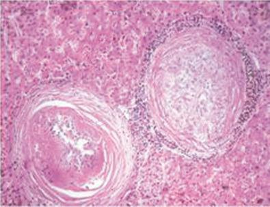 Fig. 39-2, Schistosomiasis: cicatricial granulomas with lamellar walls and a perifocal lymphohistiocytic inflammatory rim (hematoxylin-eosin stain).