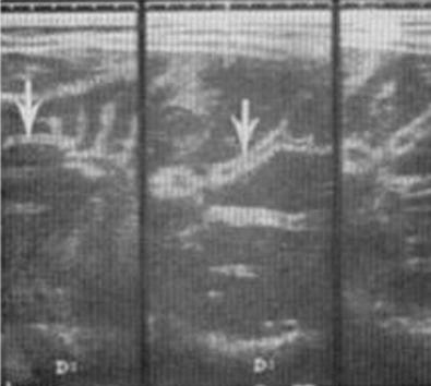 Fig. 39-3, Moderate periportal fibrosis of the liver demonstrated by ultrasonography.