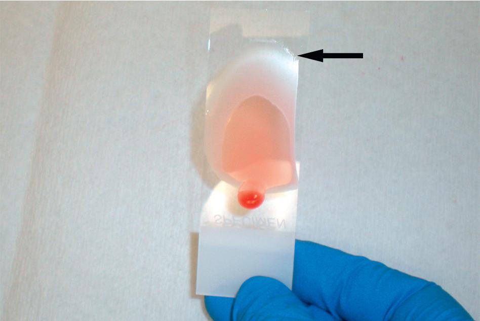 FIGURE 88.1, Thin blood film demonstrating a broad feathered edge (arrow).