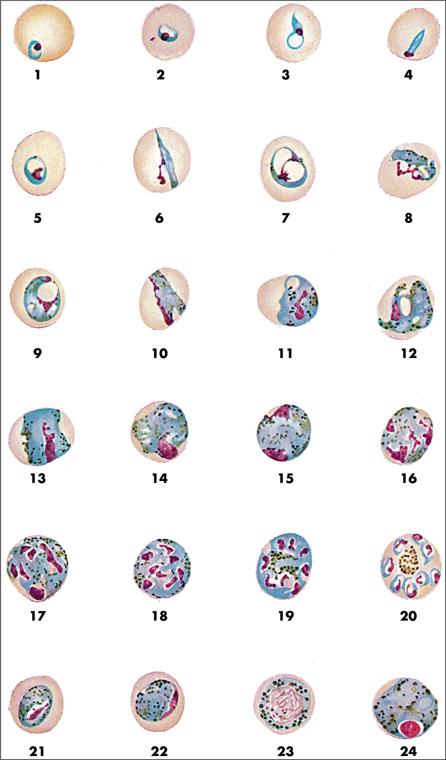 FIGURE 88.14, Life cycle stages of Plasmodium malariae . Erythrocytes infected with P. malariae have a normal or small size. Early trophozoites (rings; 1) have a relatively thick band of cytoplasm, and demonstrate an increase in cytoplasm and chromatin with maturation (2 to 5). Later-stage trophozoites may take on band forms (6, 10), basket forms (9), and other configurations (7, 8, and 11 to 14). Trophozoites become early schizonts when the chromatin mass divides, producing more than one chromatin dot (15 to 19). Eventually, mature schizonts containing 6 to 12 segmented merozoites are formed (20). The characteristic “rosette” schizont forms when merozoites align around a central pigment mass. The mature schizont will rupture to release individual merozoites that can each infect a new erythrocyte. Some parasites form early gametes rather than schizonts (21 and 22) that mature into microgametocytes (23) or macrogametocytes (24).