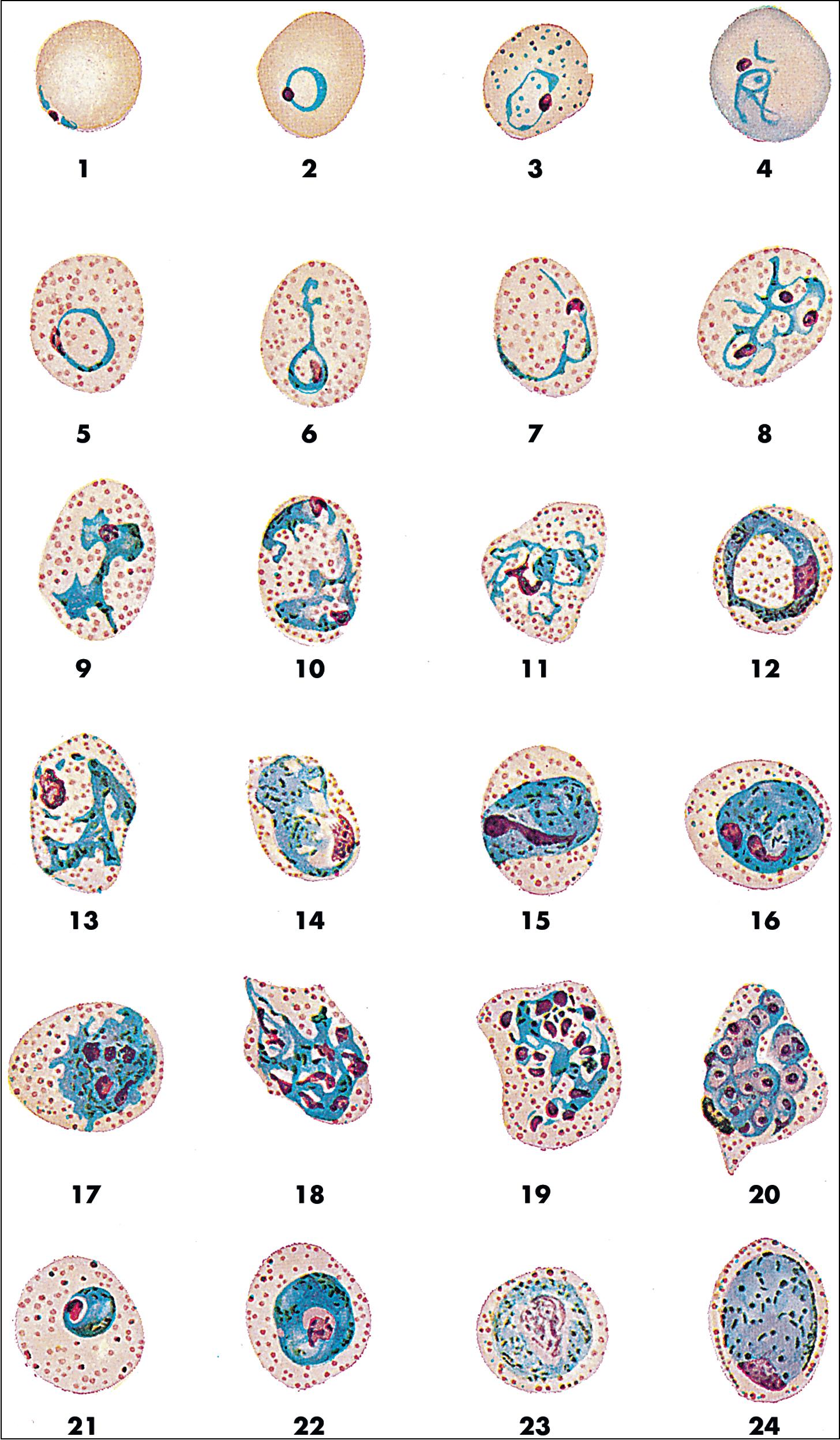 FIGURE 88.15, Life cycle stages of Plasmodium vivax . Erythrocytes infected with early trophozoites may have a normal (1) or slightly enlarged (2) size. As the trophozoites mature (3 to 15), the infected erythrocytes are uniformly enlarged, Schüffner’s stippling (numerous small blue-purple cytoplasmic inclusions) appears (when stain pH = 7.0 to 7.2), and the parasites take on an ameboid shape with formation of pseudopod-like projections. Not infrequently, doubly infected cells are seen (10). Trophozoites become early schizonts when the chromatin mass divides, producing more than one chromatin dot (16 to 19). Eventually, mature schizonts containing 12 to 24 segmented merozoites are formed (20), which will rupture to release individual merozoites that can each infect a new erythrocyte. Some parasites form early gametes rather than schizonts (21, 22) that mature into microgametocytes (23) or macrogametocytes (24).