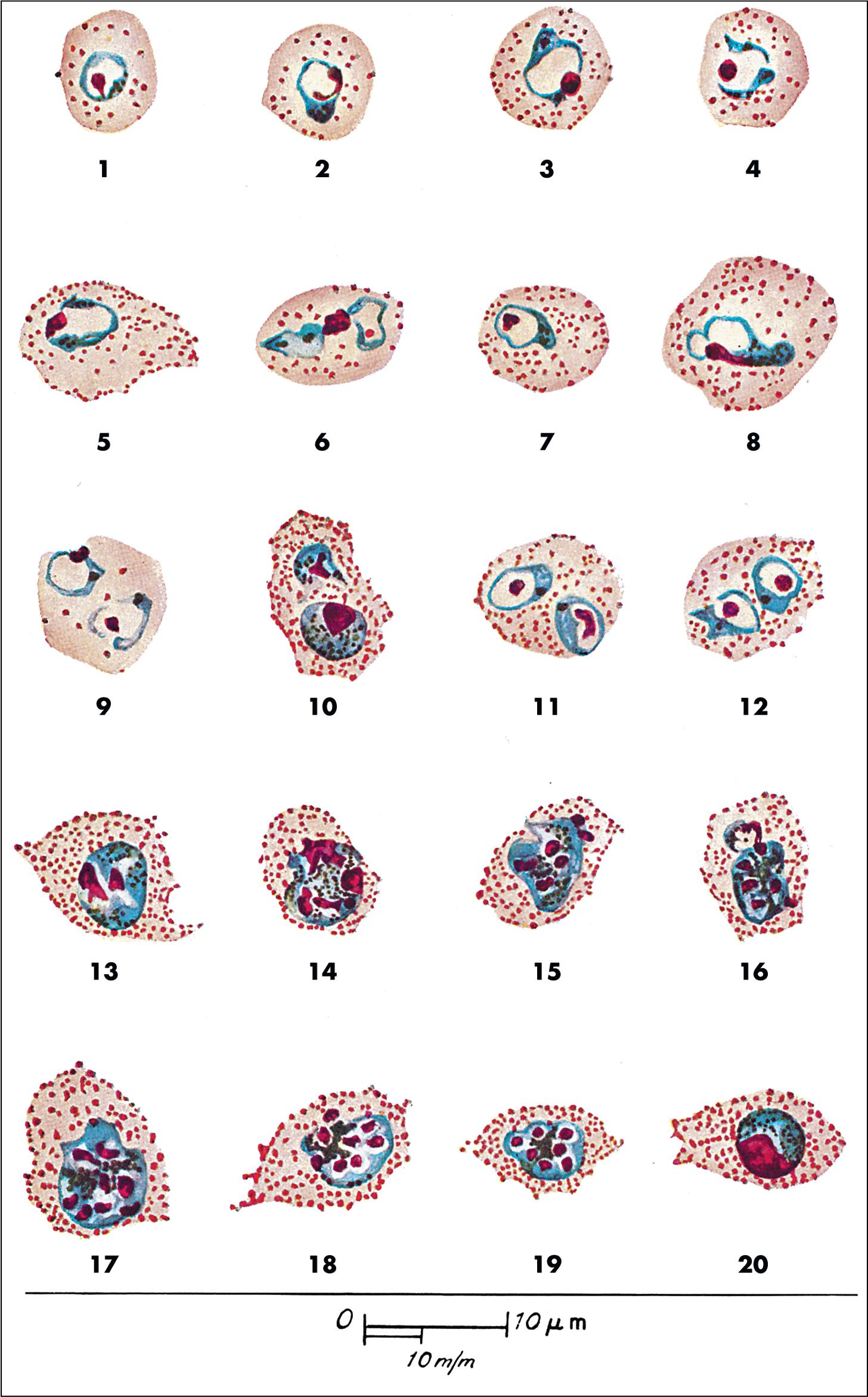 FIGURE 88.16, Life cycle stages of Plasmodium ovale . Erythrocytes infected with early trophozoites may have a normal (1 and 2) or slightly enlarged (3 to 5) size. As the trophozoites mature (6 to 9), the infected erythrocytes are uniformly enlarged, and Schüffner’s stippling (numerous small blue-purple cytoplasmic inclusions) is usually prominent (when stain pH = 7.0 to 7.2). Parasites are generally more compact than Plasmodium vivax, although ameboid forms can occasionally be seen (6 and 8). Occasionally, cells infected with two or more trophozoites (11 and 12) or two gametocytes (10) are seen. Trophozoites become early schizonts when the chromatin mass divides, producing more than one chromatin dot (13 to 16). Eventually, mature schizonts with 6 to 14 segmented merozoites will be formed (17 to 19), which will rupture to release individual merozoites that can each infect a new erythrocyte. Some parasites form gametocytes rather than schizonts (20).