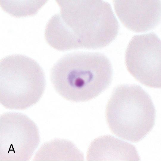 FIGURE 88.18, Representative forms of Plasmodium malariae on Giemsa-stained thin blood films (1000×): an early trophozoite (A, bird’s-eye ring form), late-stage ameboid trophozoites (B) showing a “basket” form (center) and “band” form (inset), mature schizont in a “rosette” configuration with central hemozoin pigment (C), and gametocyte (D). Note that the infected erythrocytes are normal or small in comparison to the uninfected surrounding erythrocytes.