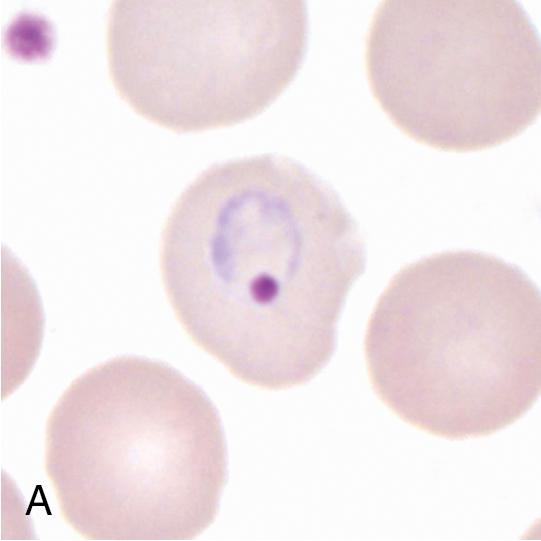 FIGURE 88.19, Representative forms of Plasmodium vivax on Giemsa-stained thin blood films (1000×): an early trophozoite (A, ring form), late-stage “ameboid” trophozoite (B), mature schizont (C), and gametocyte (D). Note that the infected erythrocytes are enlarged, somewhat molded to the contours of the neighboring cells, and Schüffner’s stippling and hemozoin pigment are seen in B–D.