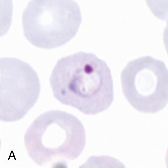 FIGURE 88.20, Representative forms of Plasmodium ovale on Giemsa-stained thin blood films (1000×): an early trophozoite (A, ring form), late-stage trophozoite (B), mature schizont (C), and gametocyte (D). Note that the infected erythrocytes are enlarged compared to uninfected erythrocytes, and Schüffner’s stippling is seen in B. Some infected erythrocytes also have a characteristic ovoid shape (B and D) and a fimbriated (jagged) edge (B).