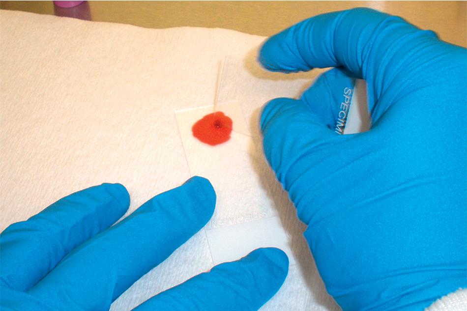 FIGURE 88.2, Preparation of a thick blood film. Gentle pressure is used to create minute scratches in the carrier slide while spreading the blood into a 1.5- to 2.0-cm-diameter film with the spreader slide. This method improves the adherence of the thick film to the carrier slide and prevents it from detaching during staining.