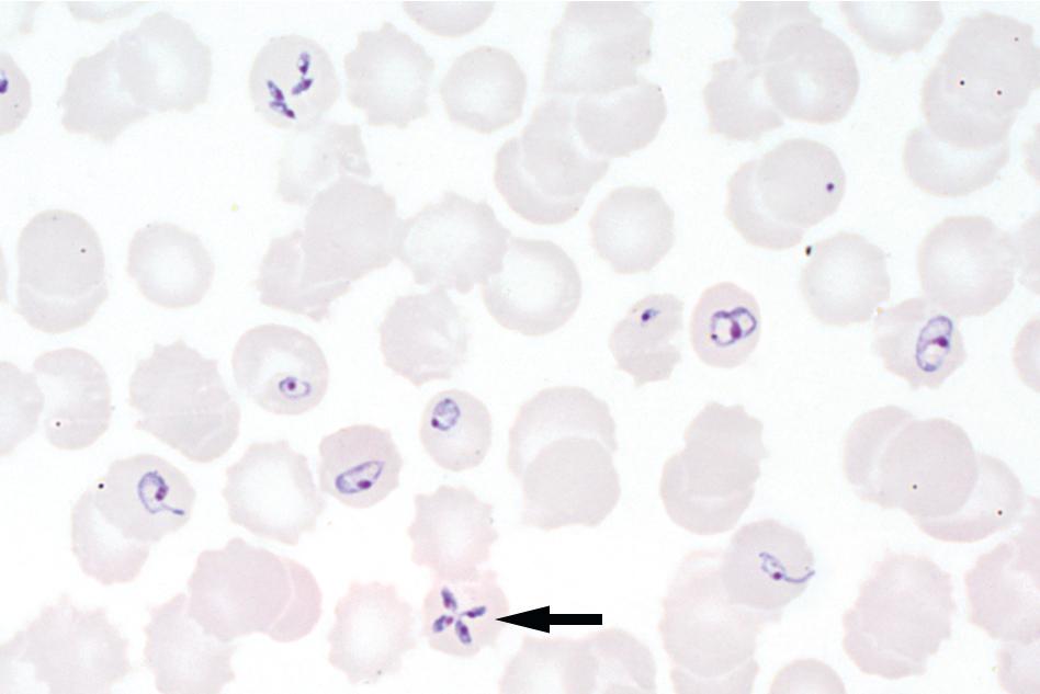 FIGURE 88.23, Babesia spp. infection seen on a Giemsa-stained thin film of peripheral blood. Note the high percentage of infected cells, irregularly shaped ring forms, multiply infected erythrocytes, and tetrad (Maltese cross) form ( arrow, 1000×). When only ring forms are seen, they must be differentiated from the similar-appearing rings of Plasmodium falciparum.