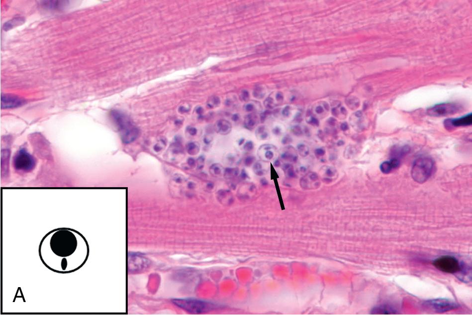 FIGURE 88.27, Amastigotes (tissue stage) of Trypanosoma cruzi (A) and Leishmania spp. (B). Each amastigote (arrows) contains a nucleus and rod-shaped kinetoplast (inset) (A, H&E; B, Giemsa, 1000×).