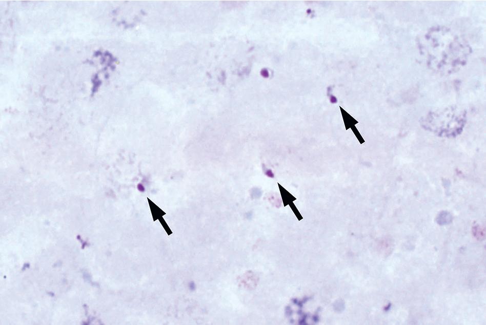 FIGURE 88.3, Thick blood film showing lysed erythrocytes and multiple early trophozoite (ring) forms of Plasmodium falciparum (arrows) (Giemsa, 1000×). Note that a red-purple chromatin dot and blue-gray cytoplasmic tail are visible on each, thereby differentiating them from Howell-Jolly bodies and nonspecific background material.