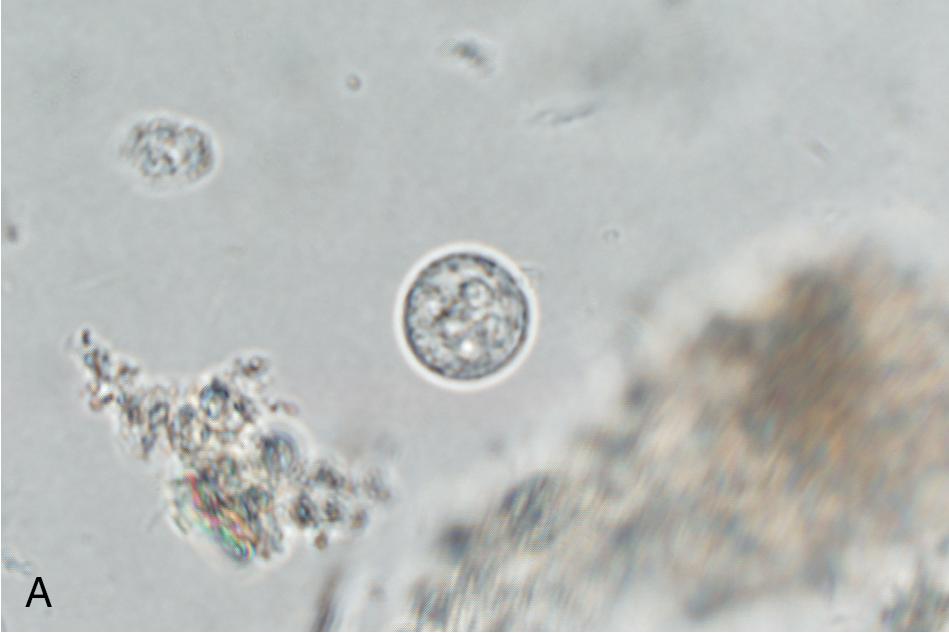 FIGURE 88.34, Entamoeba histolytica seen on wet preparations (A and B) and Wheatley’s trichrome-stained preparations (C–F) (1000×). Images are not shown to scale. (A) Quadrinucleate cyst. (B) Trophozoite. (C) Cyst showing three of the four nuclei and a chromatoid body with rounded ends (arrow). (D) Trophozoite. (E) Two trophozoites (lower right) and immature cyst (upper left). (F) Trophozoite with ingested erythrocytes in the cytoplasm. The presence of ingested erythrocytes allows for presumptive identification of E. histolytica .