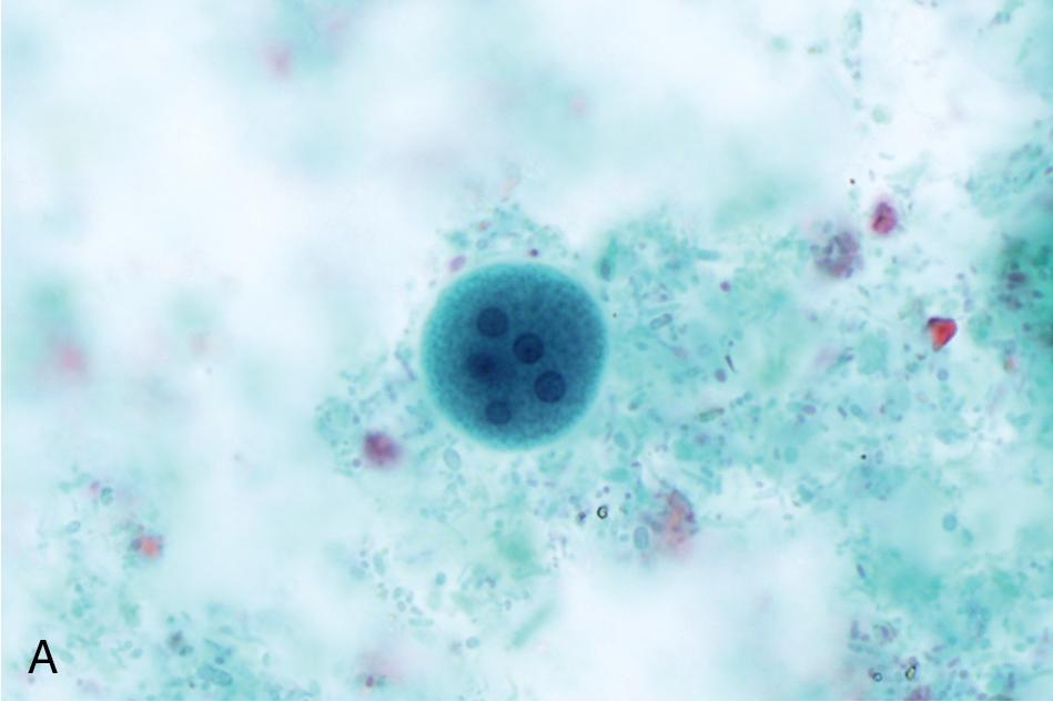 FIGURE 88.35, Intestinal amebae; Wheatley’s trichrome stain at 1000×, unless otherwise specified. (A) Entamoeba coli mature cyst with five of eight nuclei clearly visible. (B) E. coli trophozoite. Other than its larger size, it is indistinguishable from Entamoeba histolytica. (C) Entamoeba polecki trophozoites with ingested bacteria (arrow). A large irregular karyosome is present in one trophozoite (arrowhead). (D) E. polecki cyst with a ragged-ended chromatoid body (arrow). (E) Iodamoeba buetschlii trophozoite. Note that the nucleus has a large central reddish-staining karyosome (arrow) . (F) I. buetschlii cyst with characteristic vacuole (arrow). (G) Endolimax nana trophozoites trophozoite (bottom left) and cyst showing three of four nuclei (upper right). (H), Dientamoeba fragilis trophozoites showing the characteristic “fragmented”-appearing nucleus (arrow).